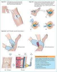Image result for Peripheral IV Access