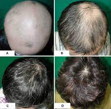 Come riconoscere la alopecia diffusa? Acute Diffuse And Total Alopecia A New Subtype Of Alopecia Areata With A Favorable Prognosis Sciencedirect