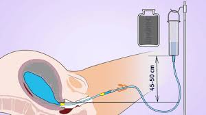 Free Flow Zhukovskiy Balloon Tamponade Animation For Vaginal Delivery Youtube
