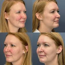 Carolina Facial Plastics