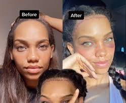 Angelina jolie, beyonce and rachel mcadams are three celebs with big foreheads that pull off the no bang look perfectly. Forehead Reduction Surgery A Woman On Tiktok S Story