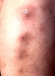 Tuberculosis (tb), contagious, wasting disease caused by any of several mycobacteria. Dermatologija Erythema Induratum Bazinove Informacije O Bolesti 2021