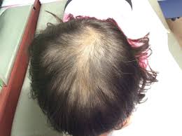 Pulse methylprednisolone for alopecia areata. Alopecia Areata And Hypothyroidism Endocrinology