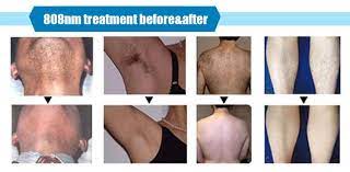 2 In 1 Diode Laser Tattoo Removal Penis Hair Removal Machine Buy Penis Hair Removal Machine Penis Hair Removal Machine Penis Hair Removal Machine Product On Alibaba Com