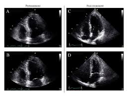 Symptoms can include shortness of breath, chest pain, decreased ability to exercise, and an irregular heartbeat. Rapid Resolution Of Acute Fulminant Myocarditis After Ivig And Steroid Treatment