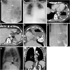 Early postoperative imaging after non-bariatric gastric resection: a primer  for radiologists