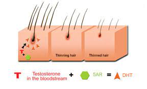 Although higher levels of testosterone are suggested to increase the level of dht, which in turn stimulates androgen action on hair follicles characteristic of male pattern baldness, this study observed no link between hair loss and testosterone levels. Dht How Does It Cause Hereditary Hair Loss Hair Growth Specialist