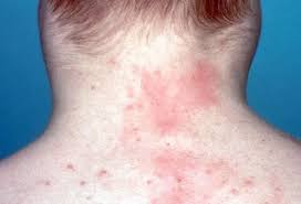 Image result for Lymphoma