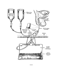 Image result for Continuous Bladder Irrigation