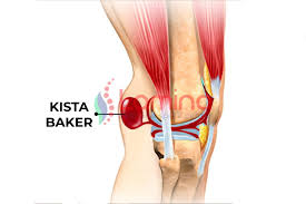 Lutut sakit sering disertai dengan keluhan lutut terasa kaku, sulit diluruskan, atau nyeri lutut biasanya terasa lebih hebat pada saat lutut digerakkan. Benjolan Di Belakang Lutut Atau Kista Baker Klinik Patella