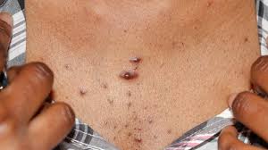 How do i get rid of a keloid. Keloid Scars Symptoms Causes And Treatments