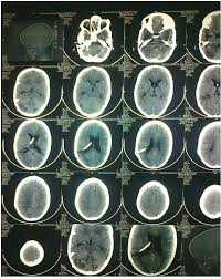 Brain Ct Scan Before Extraction Of Ventriculoperitoneal Shunt Download Scientific Diagram