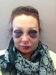 Brave woman took selfies of her battered face over six weeks to document  the shocking reality of domestic violence after her ex broke her jaw and  shattered her eye socket