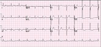 33% with confirmed mi have no chest pain on presentation (especially older, female, dm, chf) 5% of nstemi will develop cardiogenic shock (60% mortality) age >65 with mi and anemia had 33% reduction in 30 day mort if transfused to keep hct >30. A 54 Year Old Man With An Nstemi And Upcoming Non Cardiac Surgery American College Of Cardiology