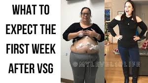 first week after vsg what to expect