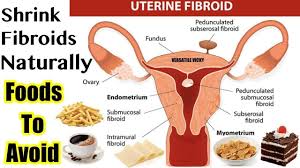 I've noticed that my periods are getting lighter and shorter since going low carb. Foods To Eat To Shrink Fibroids Fibroid Shrinking Foods Youtube