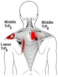 Fun for all ages (4+), trapezius makes a great bonding experience or celebration. Referred Pain Patterns Red From The Upper And Middle Trapezius Muscle Download Scientific Diagram