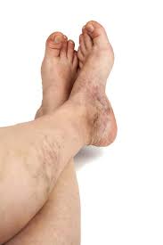 Hyperpigmentation is any discrete or blotchy brown discoloration and is most often caused by an injury to the skin. Signs Of Vein Disease Darkened Skin Truffles Vein Specialists