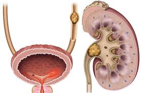 Kidney Stone Surgery Kidney Stones Kidney Stone Diet Renal Calculi