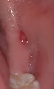 When i rub my tounge on across the roof of my mouth it feels like really tiny granules are up there. What Is That Reddish And Transparent Looking Bump Within My Mouth Pic On The Answer Quora