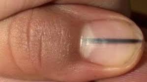 وتحذر عندما تري الخط الأسود في إصبع القدم لأنه يعني وجود سرطان الظفر والذي يمكن أن يتطور إلي سرطان الجلد في حالة. Ø¥Ø°Ø§ Ù„Ø§Ø­Ø¸Øª ÙˆØ¬ÙˆØ¯ Ø®Ø· Ø£Ø³ÙˆØ¯ ÙÙŠ Ø£Ø¸Ø§ÙØ±Ùƒ ÙÙ‡Ø°Ø§ Ù…Ø§ ÙŠØ¹Ù†ÙŠ Ø«Ù‚Ù Ù†ÙØ³Ùƒ
