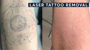 What can remove a tattoo besides laser? Laser Tattoo Removal Before And After Central London Youtube