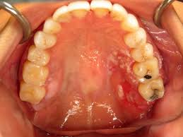 Image result for spinocellular carcinoma of the oral cavity