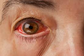 Image result for Acute Red Eye