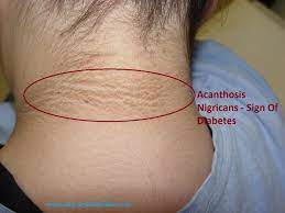 Maybe you would like to learn more about one of these? Darkening Behind Neck Sign Of Diabetes Dr Nikhil Prabhu S Blog Diabetes Care