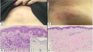 In the united states, it's estimated that doctors diagnose over 100,000 new skin cancer cases each year. Cutaneous Breast Cancer Metastases Successfully Treated Using An Oxygen Flow Assisted Topical Administration Of Methotrexate Ofamtx Springerlink