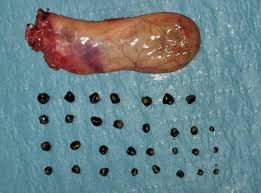 Image result for Gallstone