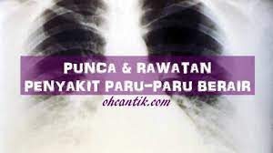 Paru paru berair berlaku apabila terdapat pengumpulan cecair yang berlebihan di dalam paru paru. Punca Paru Paru Berair Tanda Sokongan Rawatan Ohcantik Com