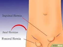 Do you think you have a hernia?what are hernias? How To Check For A Hernia 6 Steps With Pictures Wikihow