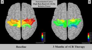 View 5.11 unit test.docx from health sciences oth080 at k¹² international academy. Frontiers Coordinated Reset Vibrotactile Stimulation Induces Sustained Cumulative Benefits In Parkinson S Disease Physiology