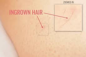 Leaves of aloe vera plant are used in topical creams in order to reduce razor bumps and ingrown hair. Hair Removal Flat Ingrown Hairs On Legs Skincareaddiction