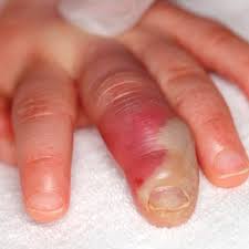 13.04.2020 · selingkuh anak kandung ibu kandung sedarah. Nejm On Twitter An Analysis Of An Oral Lesion In This 1 Year Old Girl Was Positive For Herpes Simplex Virus Type 1 Confirming A Diagnosis Of Herpetic Whitlow Https T Co Sai1w6856v Https T Co Fsbsb00eww