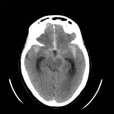 Image result for CT Head