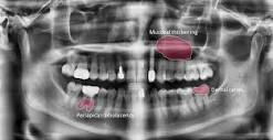 Detecting dental diseases with AI dental image analysis