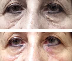 What are the other treatment options for xanthelasma? Xanthelasma Before After