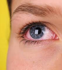 Welder S Flash Burn Or Arc Eye Natural Treatment 10 Home Remedies
