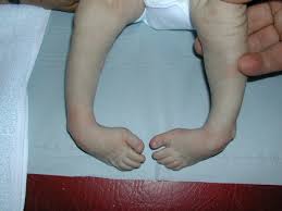 We did not find results for: Clubfoot Or Talipes Children Clubfoot Children Talipes Ponseti Method