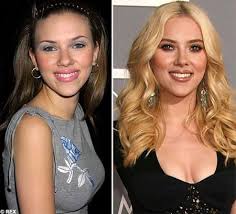 8 Most Successful Celebrity Nose Jobs Hair Implants Celebrities Before And After Nose Job