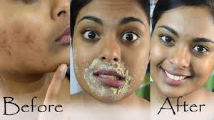 These deposits, in turn, result in a gradual darkening of the skin. How To Get Rid Of Hyperpigmentation And Dark Upper Lip Simple Craft Ideas