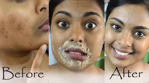 These deposits, in turn, result in a gradual darkening of the skin. How To Get Rid Of Hyperpigmentation And Dark Upper Lip Simple Craft Ideas