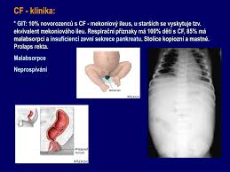 Cystická fibróza trápí nejen vás. Ppt Cysticka Fibroza Mukoviscidoza Powerpoint Presentation Free Download Id 4731515