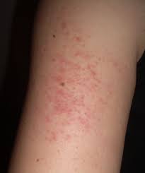 Keratosis Pilaris Arm Bumps Located On Arms Or Thighs Microdermabrasion Or Chemical Home Remedies For Razor Bumps Keratosis Pilaris Treat Keratosis Pilaris