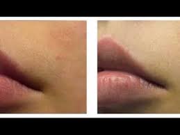 Here you may to know how to bleach mustache. Bleach Upper Lip Hair Youtube