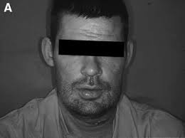 Diagnosis and treatment of necrotizing fasciitis in the head and neck region