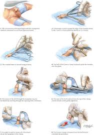 Image result for Neonatal Circumcision