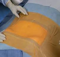 Customized Disposable Sterile Adhesive Transparent Surgical ...